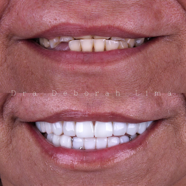 Foto 2 de Dra. Deborah Lima - Facetas em Resina, Implante Dentário