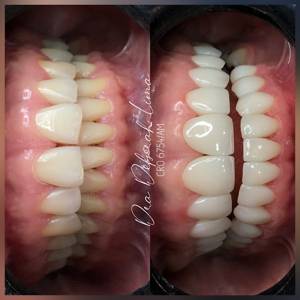 Foto 3 de Dra. Deborah Lima - Facetas em Resina, Implante Dentário
