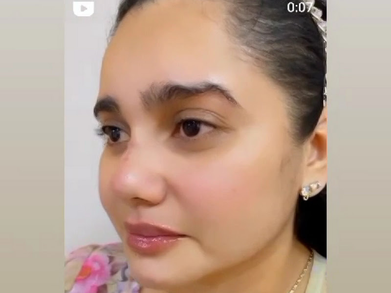 Foto de Dra.Diana Braga | Preenchimento Labial | Harmonização facial em Manaus