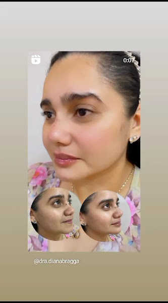 Foto 2 de Dra.Diana Braga | Preenchimento Labial | Harmonização facial em Manaus