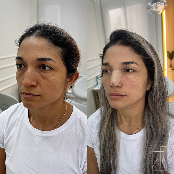 Foto 2 de Dra. Elaine Rikely / Reestruturação Facial