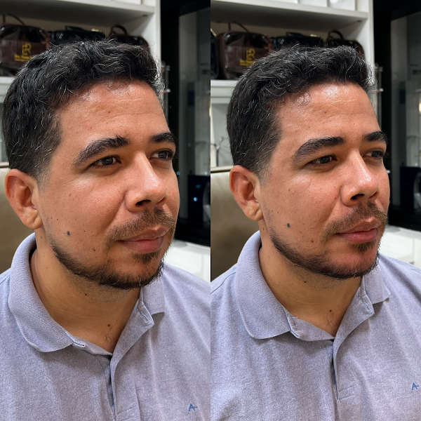 Foto 3 de Dra. Elaine Rikely / Reestruturação Facial