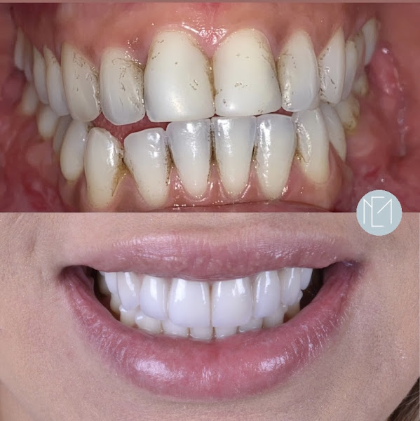 Foto 3 de Dra. Elisa Macedo - Dentista Moema | DTM e dor Orofacial, Bruxismo, Prótese, Facetas, Clareamento