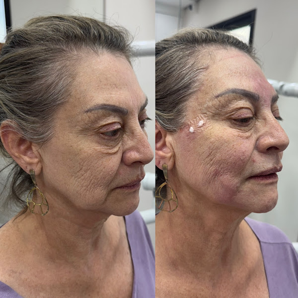 Foto 3 de Dra Eliss Amaral | Harmonização Facial | Botox - Santos