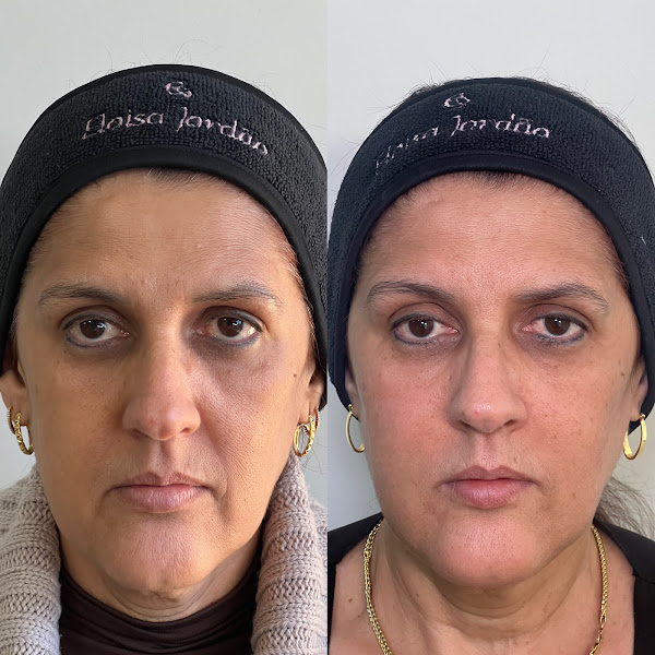 Foto 3 de Dra. Eloisa Jordão- Harmonização facial e odontologia