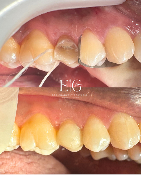 Foto 3 de Dra. Emanuely Gervasio - dentista em Ipatinga MG / Clareamento dental / Aparelho invisível / Laserterapia