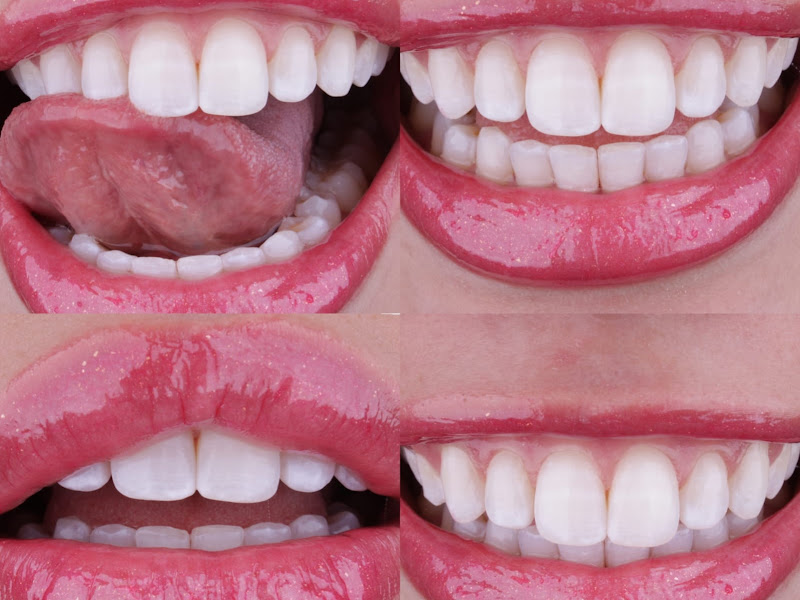 Foto 9 de Dra. Emanuely Gervasio - dentista em Ipatinga MG / Clareamento dental / Aparelho invisível / Laserterapia