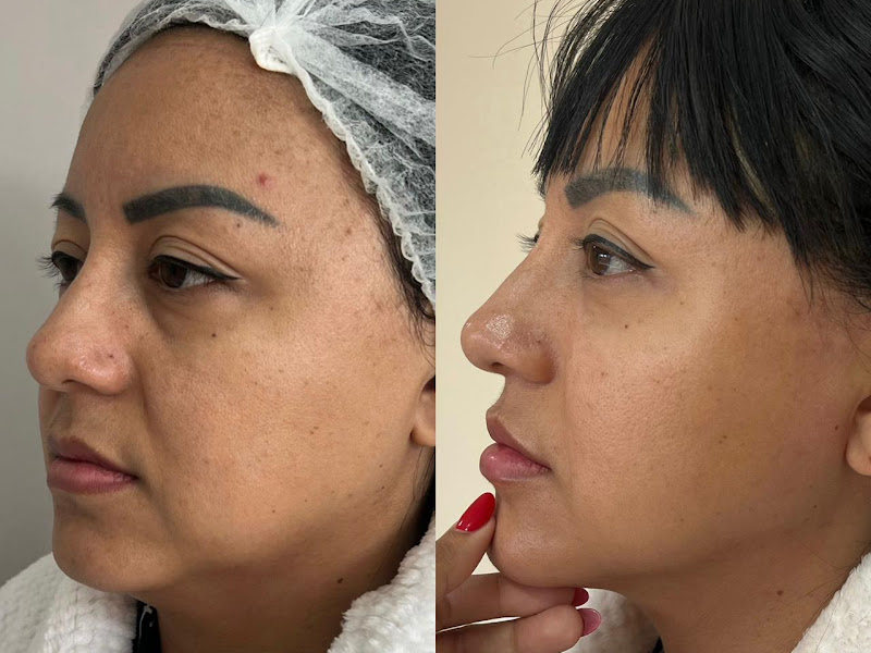 Foto 3 de Dra Emille Magalhães - Harmonização Facial
