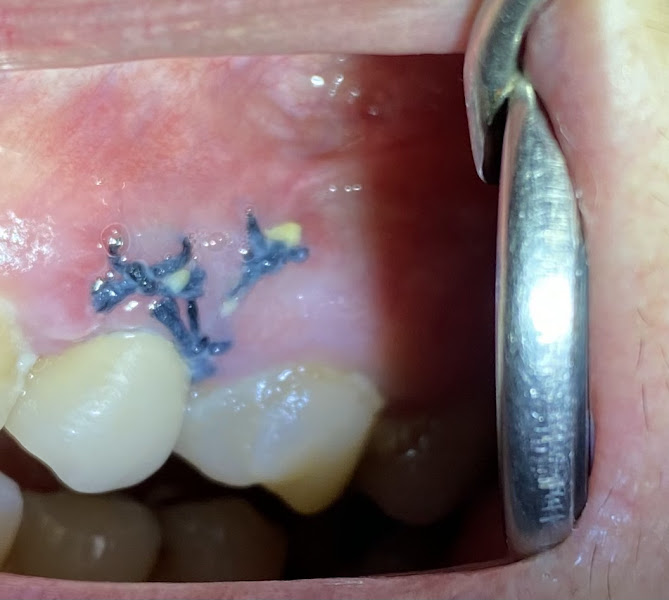 Foto 3 de Dra. Erika Padula, Dentista na Vila da Penha Clareamento Dental Harmonização facial, Implante Oral e Ortodontia