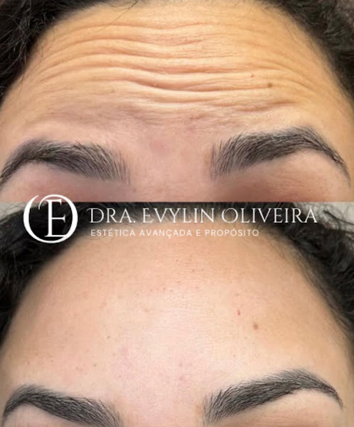 Foto 2 de Dra. Evylin Oliveira | Harmonização Facial | Tratamentos de Pele