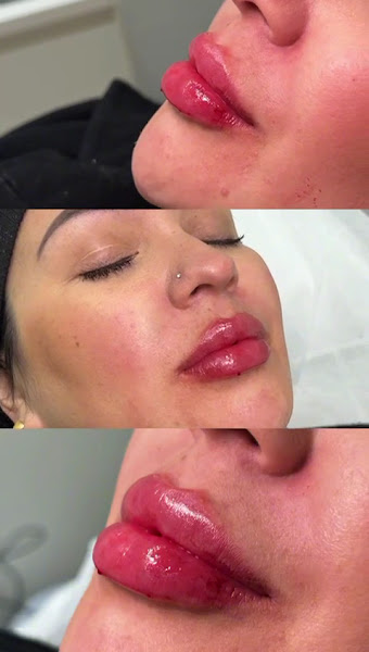 Foto 3 de Dra. Evylin Oliveira | Harmonização Facial | Tratamentos de Pele