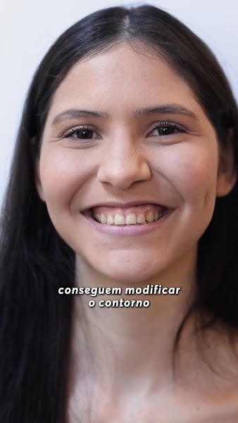 Foto 3 de Dra. Fabiana Nunes Leite - Facetas de resina em Petrolina | Periodontista em Petrolina