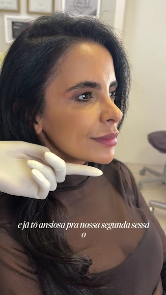 Foto 3 de Dra. Fernanda Baboni | Harmonização Facial em Curitiba | Facetas de Resina