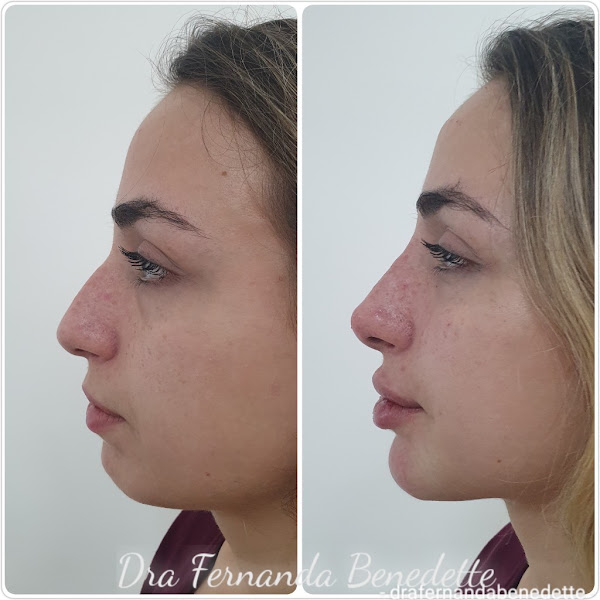 Foto 3 de Dra Fernanda Benedette - Harmonização Facial em Santo André