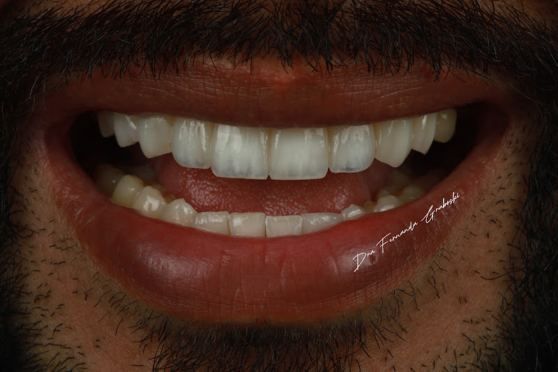 Foto 3 de Dra. Fernanda Graboski | Facetas em Resina e Odontologia Biomimética