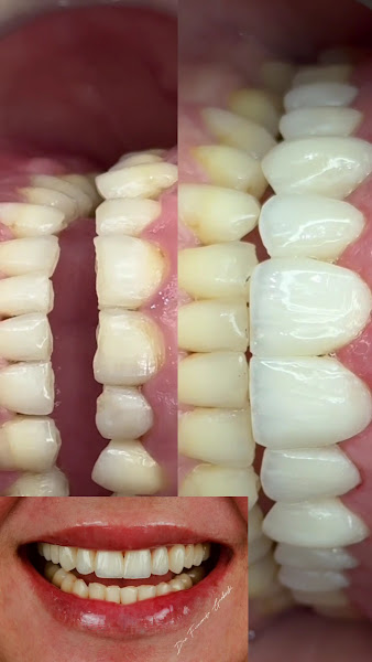 Foto 4 de Dra. Fernanda Graboski | Facetas em Resina e Odontologia Biomimética