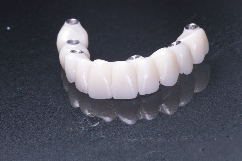 Foto 4 de DRA. FERNANDA GUSMÃO | VIVAZ ODONTO | IMPLANTE E PROTESE