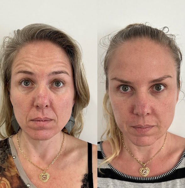 Foto 2 de Dra. Fernanda Lino | Harmonização Orofacial