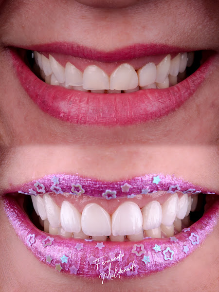 Foto 2 de Dra Fernanda Maldonado | Lentes em Resina e Porcelana