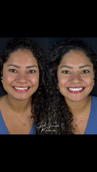 Foto 3 de Dra Fernanda Maldonado | Lentes em Resina e Porcelana