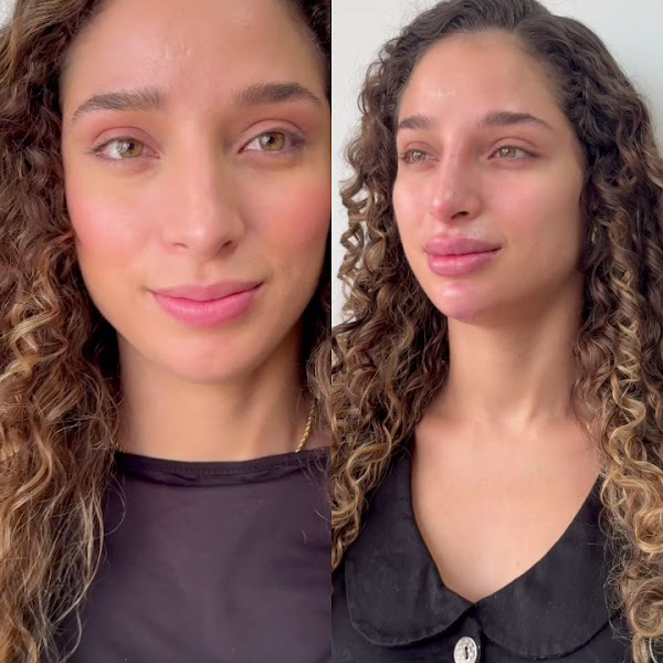 Foto 3 de Dra.Fernanda Matos - Harmonização facial