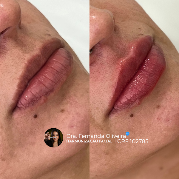 Foto 2 de Dra Fernanda Oliveira - Especialista em Harmonização facial