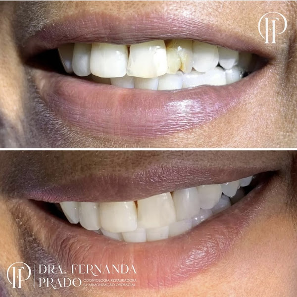 Foto 3 de Dra Fernanda Prado | harmonização orofacial