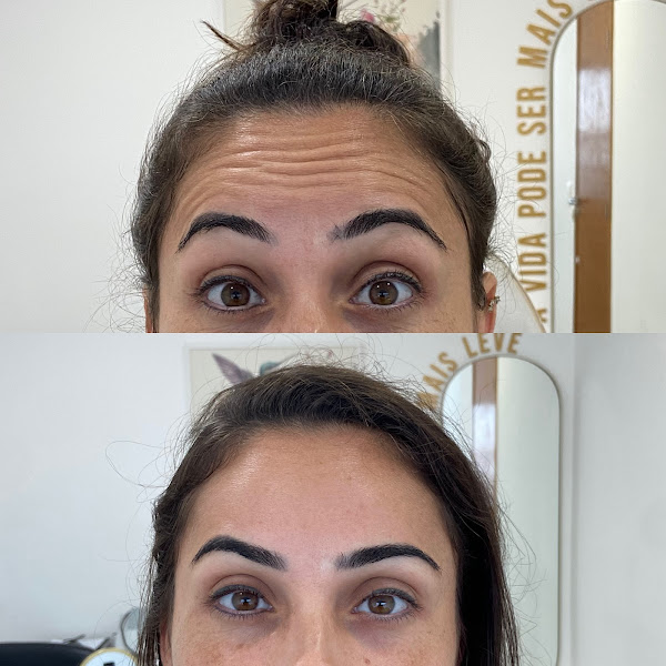 Foto 3 de Dra. Fernanda Prado - Praia Grande - Harmonização facial / Perfiloplastia