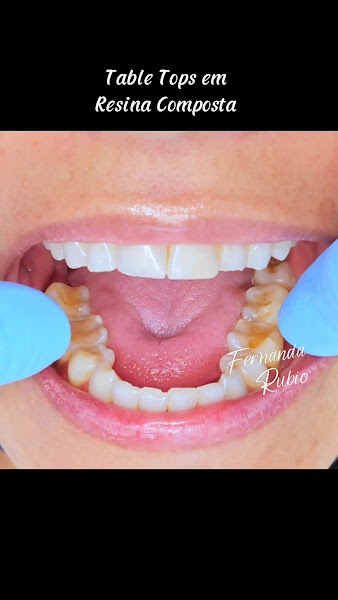 Foto 4 de Dra Fernanda Rubio - Facetas, Lentes e Harmonização Facial