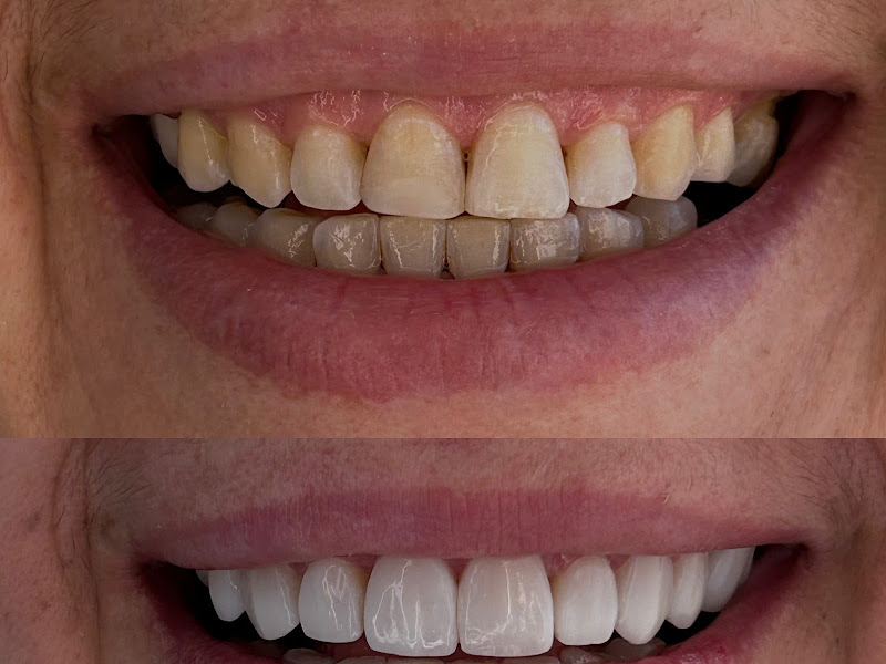 Foto 9 de Dra. Fernanda Thiesen | Extração de Siso São Leopoldo | Implante Dentário