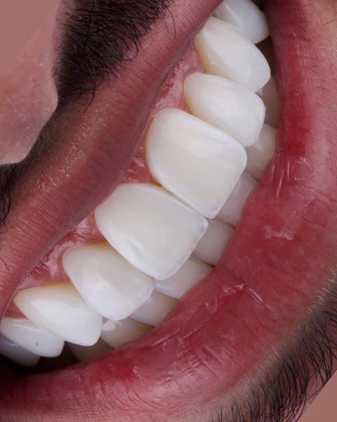 Foto 2 de Dra Flávia Benedikt | Dentista | Facetas de Resina