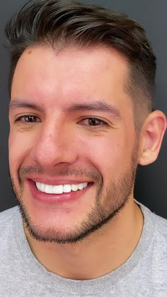 Foto 3 de Dra Flávia Benedikt | Dentista | Facetas de Resina