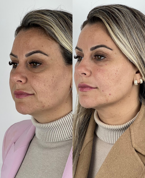 Foto 3 de Dra. Francielle Delavedova - Harmonização Facial