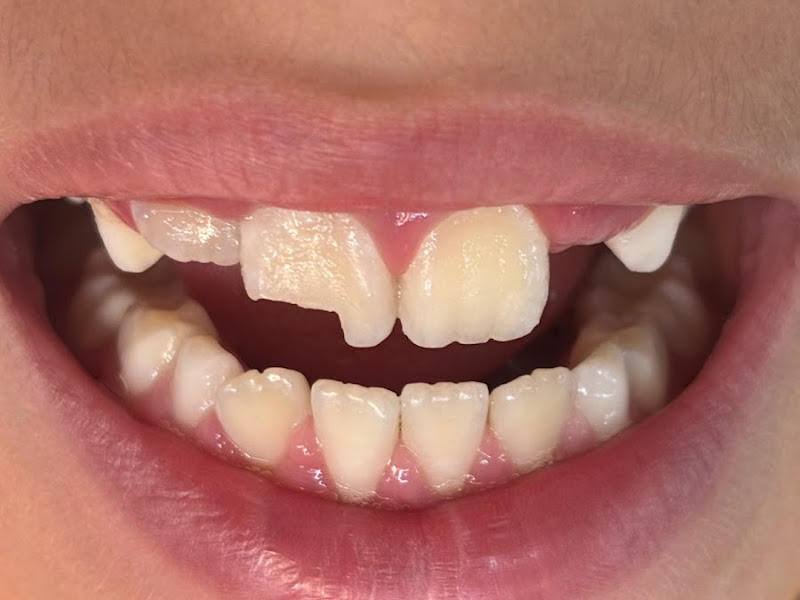 Foto 7 de Dra. Gabriela Baldessim - implantes I lentes em resina em Piracicaba | CROSP 130285