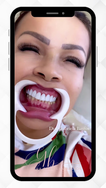 Foto 3 de Dra Gabriela Bastos | Facetas | Lentes de Contato | Harmonização Orofacial