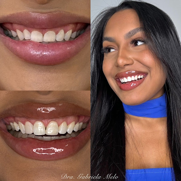 Foto 2 de Dra. Gabriela Melo - Cirurgiã Dentista