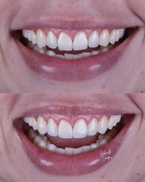 Foto 2 de Dra. Gabrielle Campos | Odontologia Estética | Facetas em Resina | Santa Cruz do Sul