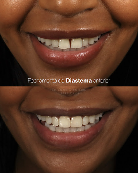 Foto 3 de Dra. Gabrielle Crestani Dutra - Odontologia Estética & Reabilitação Oral