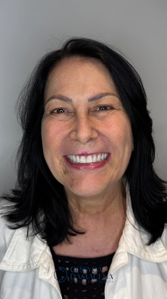 Foto 3 de Dra Gessyca Damacena - Implante dentário - Implante Protocolo