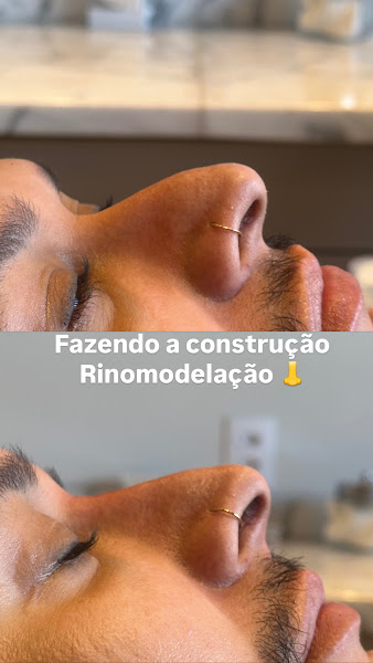 Foto 2 de Dra. Giovana Albuquerque Harmonização Facial - Itapetininga