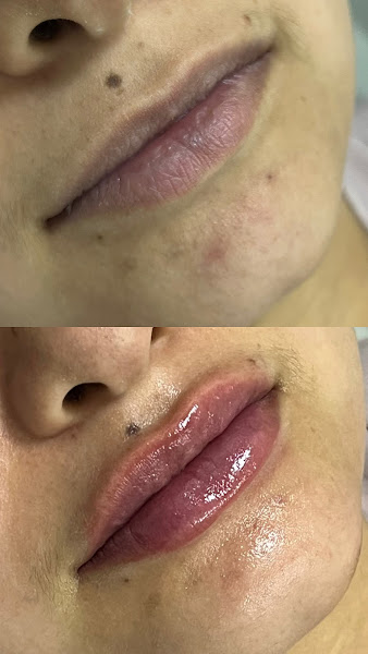 Foto 3 de Dra. Gisa Nunes - Harmonização Facial