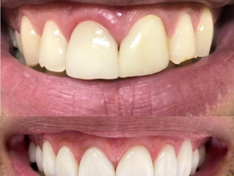 Foto 6 de Dra. Gisele Da Dalt | Especialista em Prótese dentária | Implantes | Prótese fixa