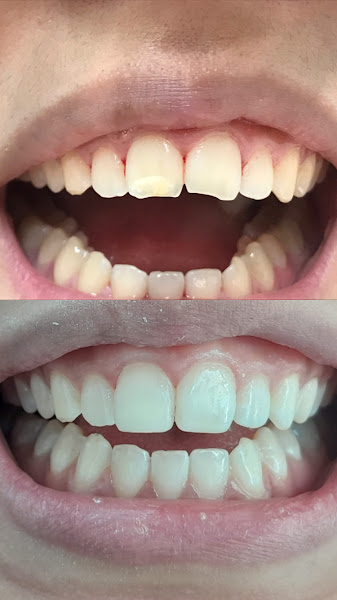 Foto 3 de Dra Giulianne / Implantes dentários / Aparelho invisível / Dentista Paraíso / Clareamento / Crianças atípicas