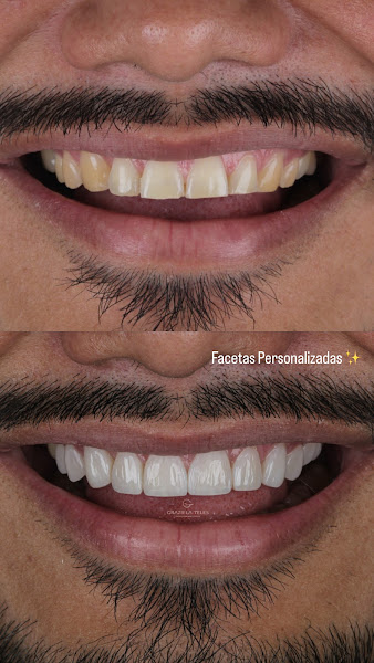 Foto 3 de Dra Graziela Teles| Facetas em Resina Manaus| Porcelana | Dentista | Harmonização Orofacial