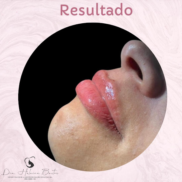 Foto 3 de Dra. Helaine Bastos Clínica Estética/Harmonização Orofacial