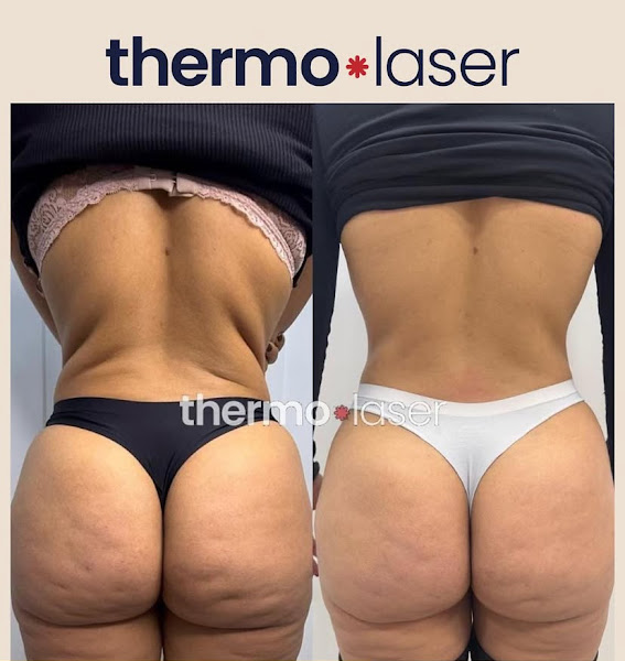 Foto 3 de Dra Helcrijane Santos | Harmonização Glútea | Thermolaser | Perfiloplastia | Feira de Santana - BA