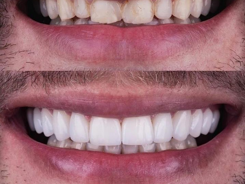 Foto 6 de Dra. Hewelyn Reis I Facetas em resina composta em Manaus