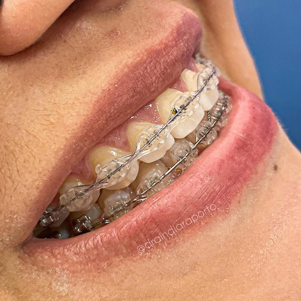 Foto 3 de Dra Indiara Porto - Dentista em Teófilo Otoni/MG