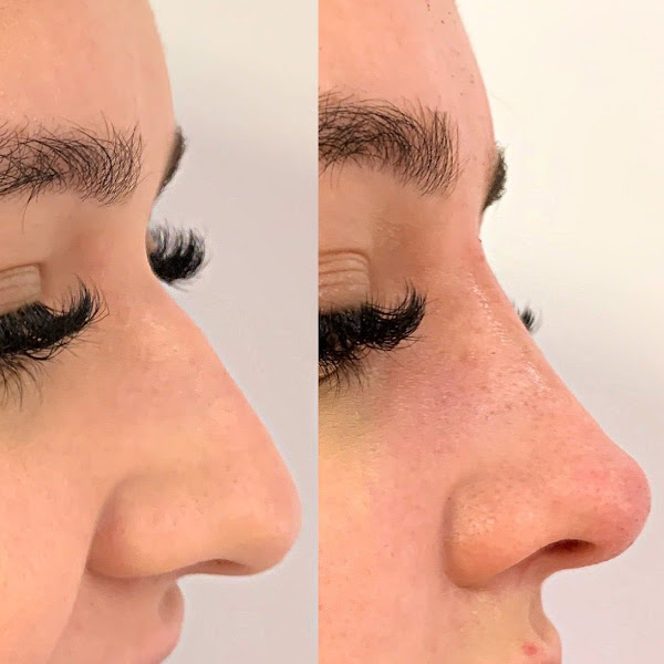 Foto 3 de Dra. Isabela Belló - Harmonização Facial