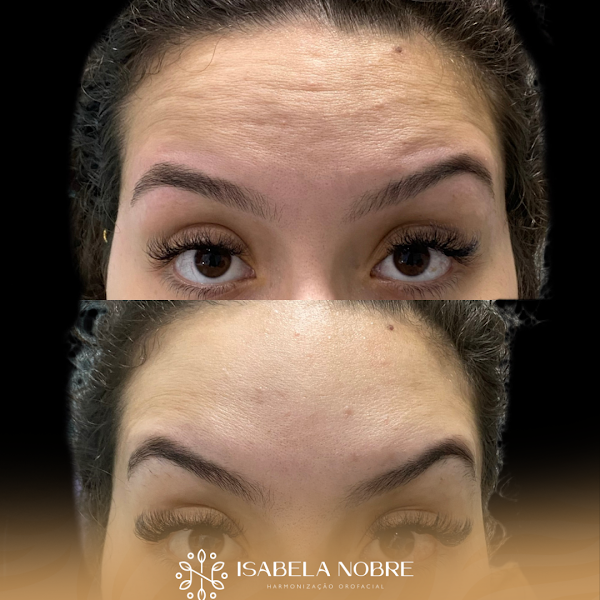 Foto 3 de Dra Isabela Nobre | Harmonização Facial